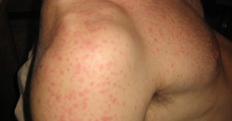 Az allergiás kiütések kezelése könnyen megoldható